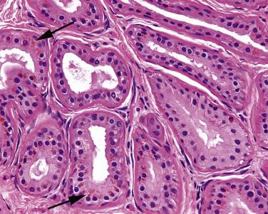 FIG. 30.6, The yellow-brown pigmentation granules (arrows) in the cytoplasm help to confirm ceruminous differentiation and the benign nature of the tumor.