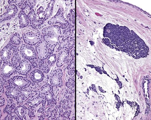 FIG. 30.7, (Left) The biphasic appearance is easily recognized with glandular elements lined by inner luminal secretory cells and surrounded by basal, myoepithelial cells. (Right) A ceruminous pleomorphic adenoma, with ceruminous glands at the far right.