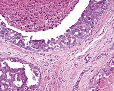 FIG. 30.10, This ceruminous adenocarcinoma, NOS shows extensive necrosis within the cystic spaces, which are lined by a highly atypical epithelial proliferation.