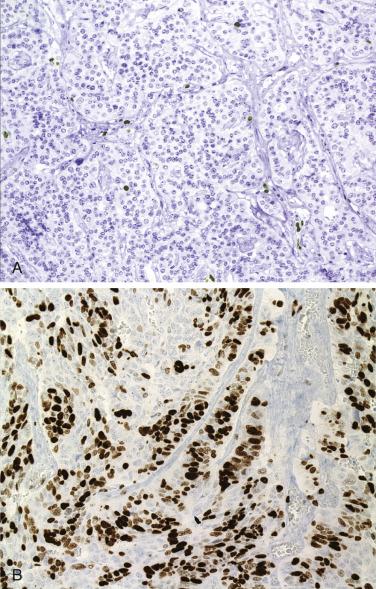 FIG. 20.1, (A) Neuroendocrine tumor of the pancreas, G1, with a Ki67-labeling below 2%. (B) Pancreatic neuroendocrine carcinoma, G3, with a Ki67-labeling exceeding 20%.