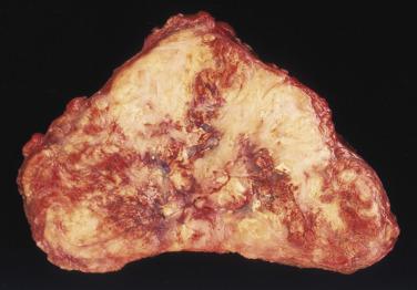 FIG. 20.11, Gross appearance of a poorly differentiated pancreatic neuroendocrine neoplasm (PanNEC) showing necrosis and hemorrhage.