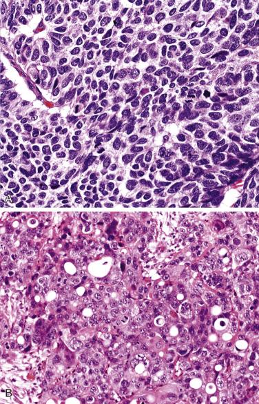 FIG. 20.12, (A) Poorly differentiated pancreatic neuroendocrine neoplasm (PanNEC) of small cell type showing chromatin dense nuclei. (B) PanNEC of large cell type with nuclei that show distinct nucleoli.