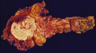 FIG. 20.2, Gross appearance of a pancreatic neuroendocrine tumor. The tumor is well demarcated from the surrounding parenchyma.