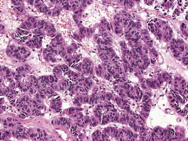 FIG. 20.3, Pancreatic neuroendocrine tumor with a trabecular growth pattern.