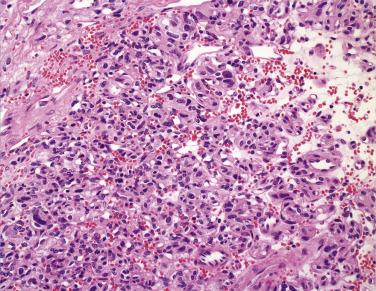 FIG. 20.5, Pancreatic neuroendocrine tumor with a paraganglioma-like pattern.