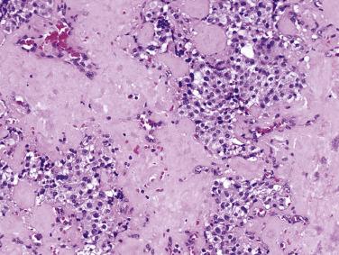 FIG. 20.6, Pancreatic neuroendocrine tumor with solid pattern and stromal sclerosis.