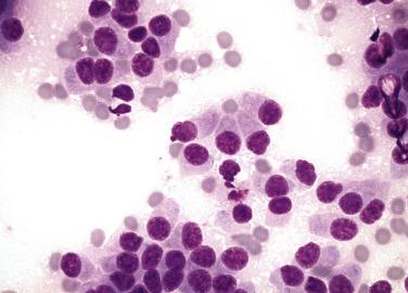 FIG. 20.8, Fine-needle aspiration cytology of a pancreatic neuroendocrine tumor showing well-differentiated cells with plasmacytoid appearance and granular cytoplasm.