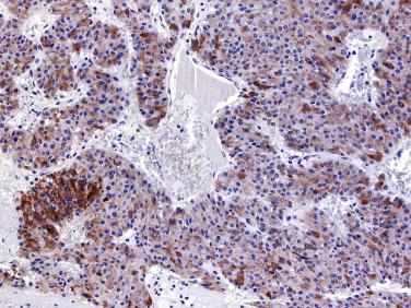 FIG. 20.10, Pancreatic neuroendocrine tumor with immunostaining for chromogranin A in the same tumor as shown in Fig. 20.9 . Chromogranin is present in many but not all tumor cells.