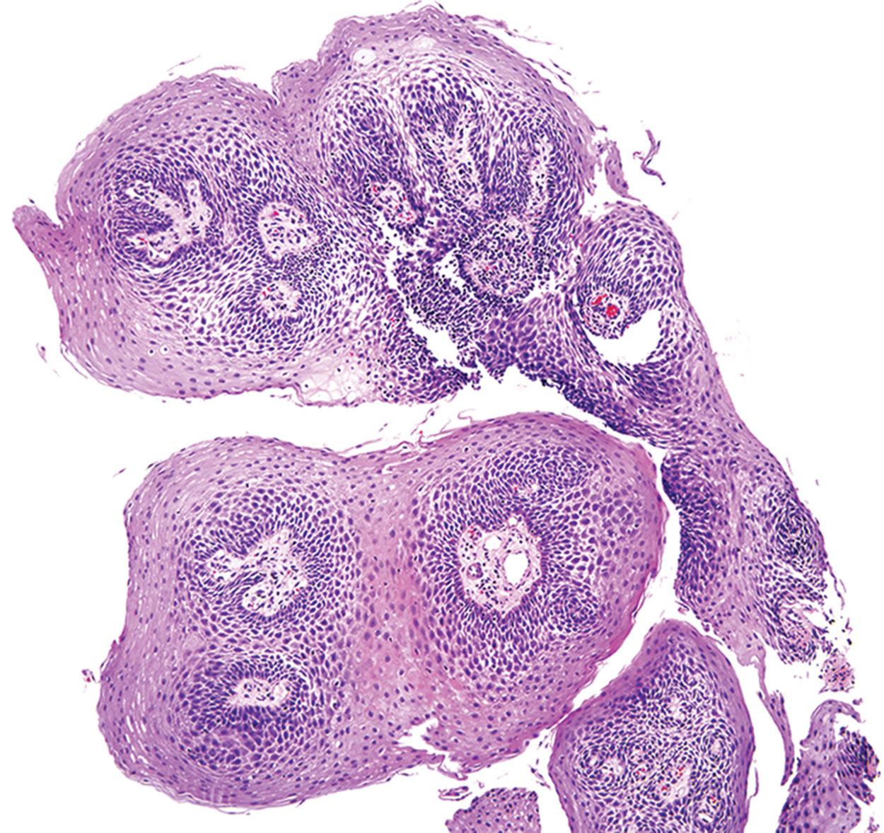 Figure 2.1, Squamous papilloma of the esophagus. Most such tumors are incidental and not associated with human papillomavirus infection.