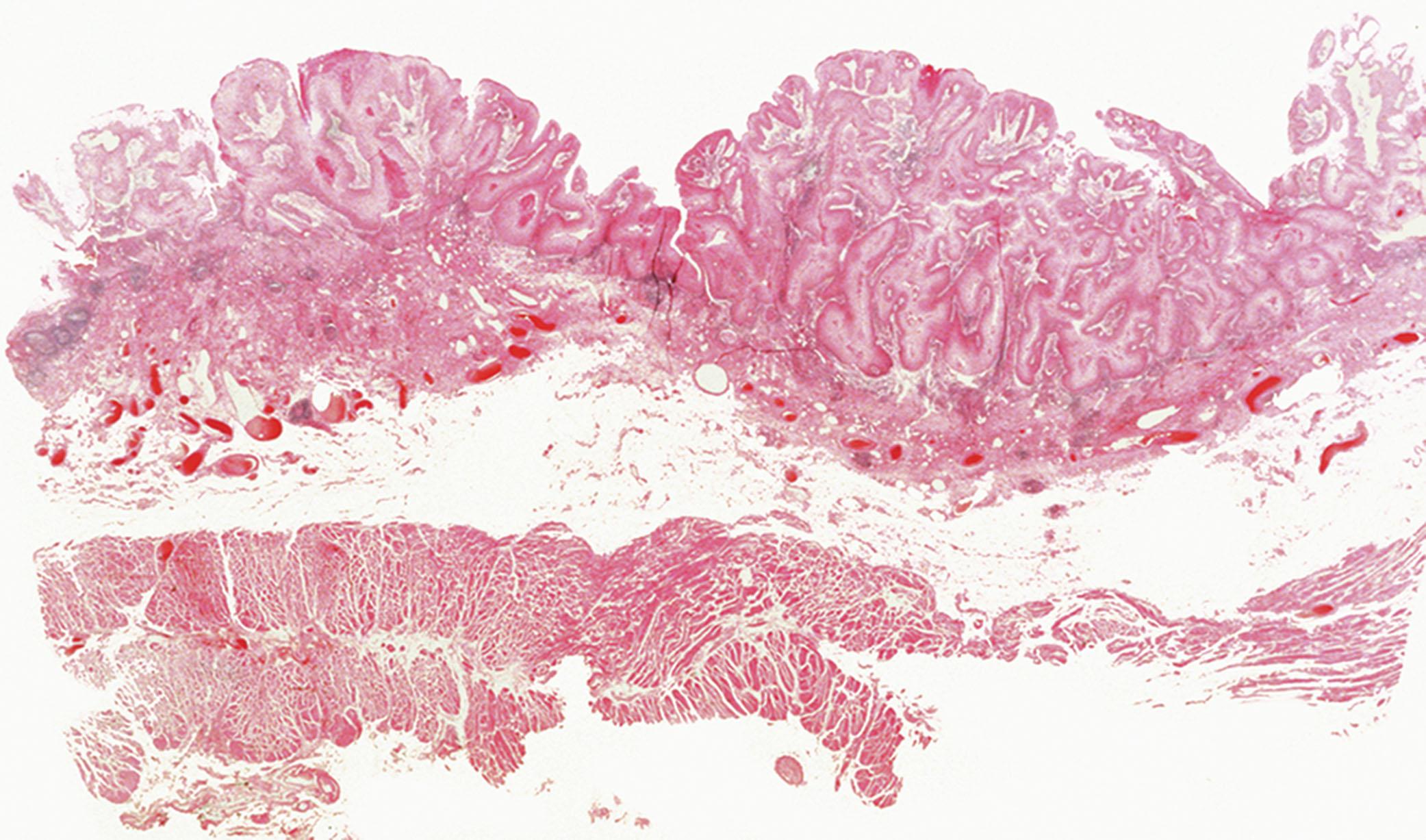 Figure 2.2, Esophageal papillomatosis in a young patient with tracheal papillomatosis associated with human papillomavirus.