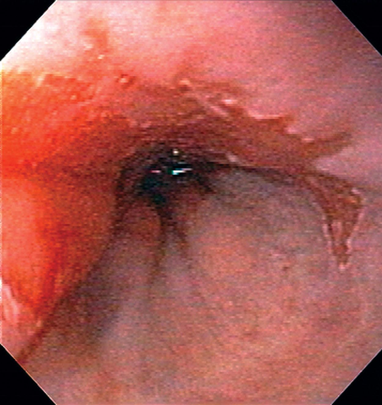 Figure 2.4, Barrett’s esophagus, endoscopic appearance. Note the tongues of salmon-colored epithelium extending into the gray squamous mucosa to a variable extent.