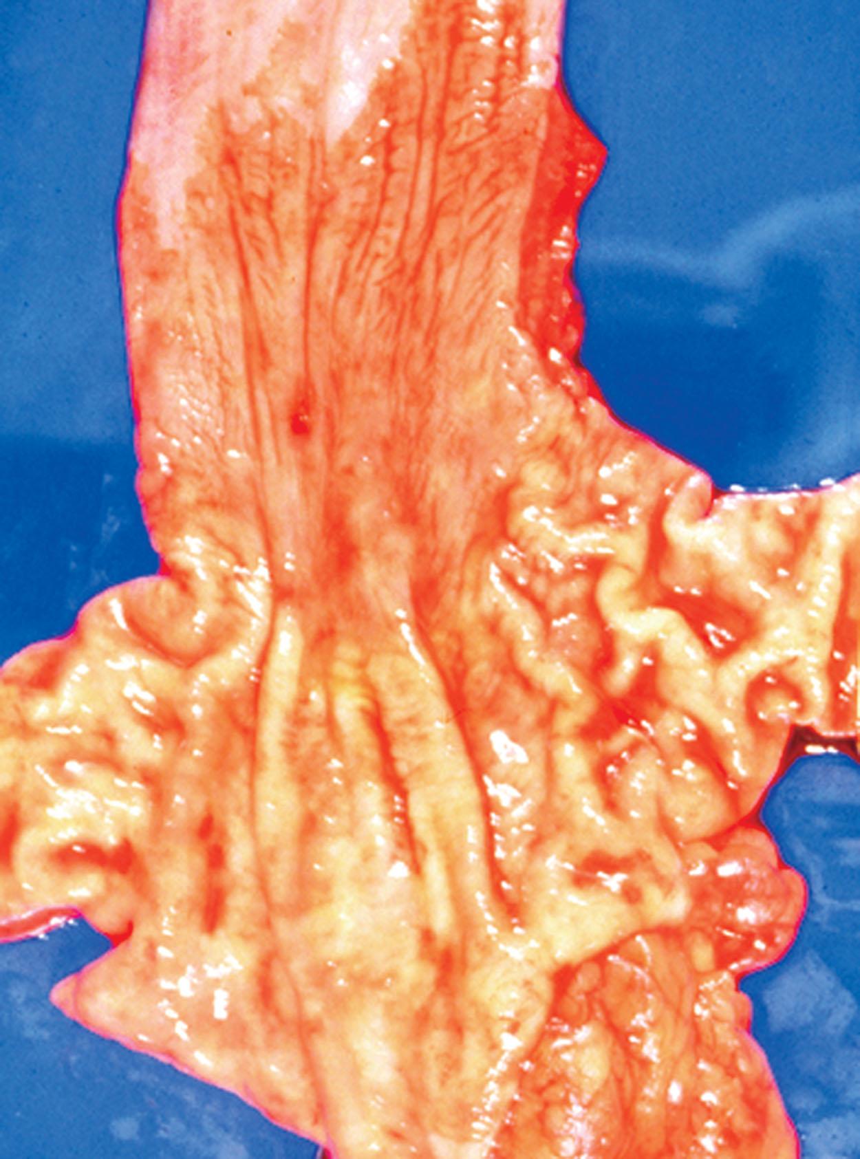 Figure 2.5, Long-segment Barrett’s esophagus, resection specimen, showing velvetlike mucosa above the anatomic gastroesophageal junction which is defined by the proximal limit of the gastric rugal folds. This esophagus was excised in 1996 because of extensive high-grade columnar epithelial dysplasia. Today, such patients are managed endoscopically by radiofrequency ablation.