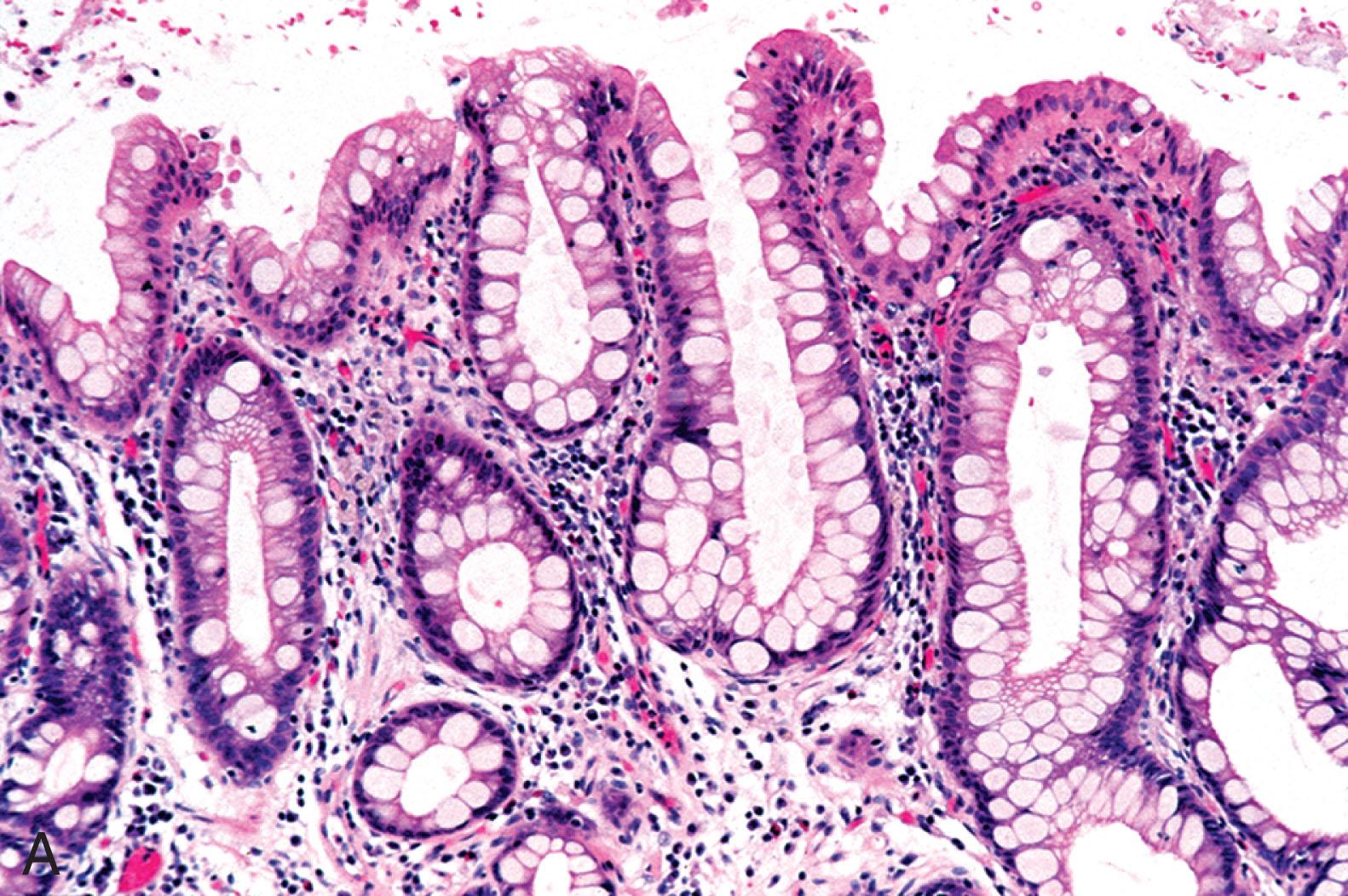 Figure 2.6, Barrett’s esophagus. This biopsy specimen came from the tubular esophagus and shows intestinal metaplasia ( A ). Periodic acid–Schiff (PAS) and Alcian Blue (AB) stains can be used to highlight goblet cells but are not necessary in routine practice. Note the blue goblet cells with interposed cells displaying neutral mucin, imparting a magenta color on the PAS AB stain. This pattern is similar to gastric foveolar cells rather than intestinal absorptive cells. This combination of cell types is termed incomplete intestinal metaplasia ( B ).