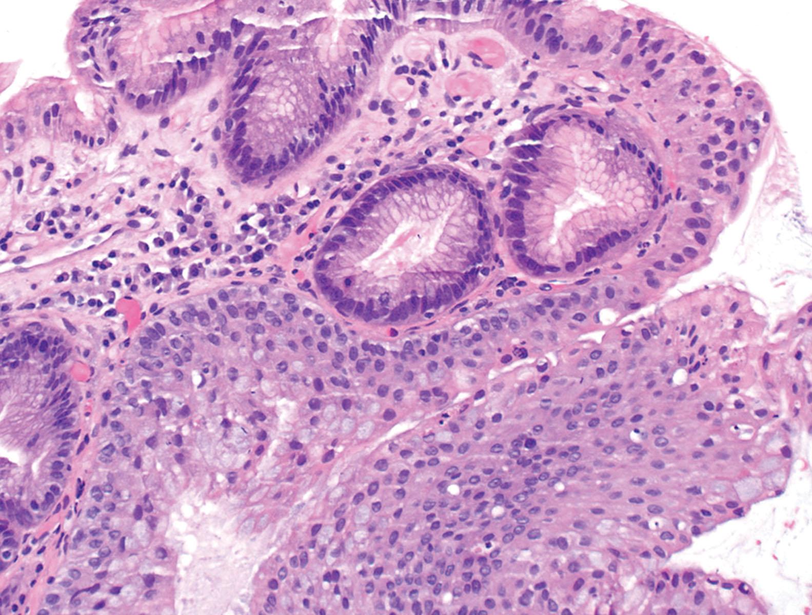 Figure 2.7, Multilayered epithelium (hematoxylin and eosin) is a hybrid epithelium demonstrating features of both squamous and columnar differentiation and suggested by may be a precursor of Barrett’s esophagus.