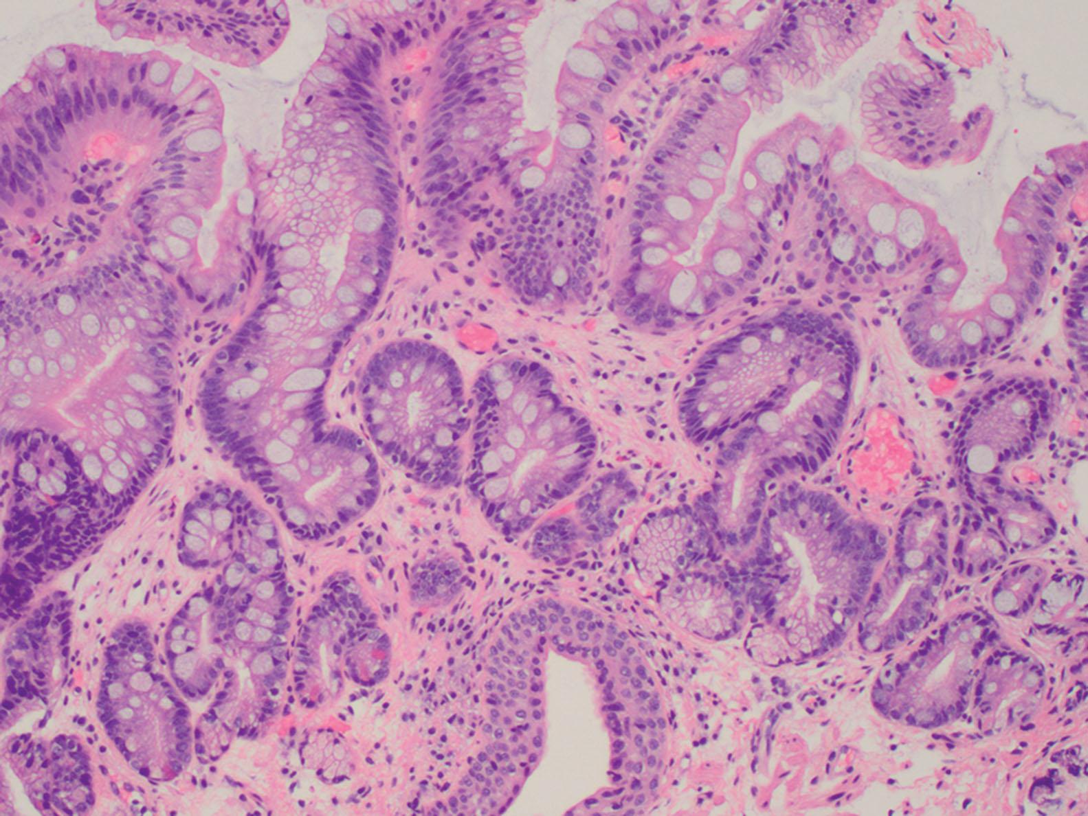 Figure 2.8, In biopsies obtained from the gastroesophageal junction, the presence of esophageal gland ducts (bottom of field) within the focus of intestinal metaplasia is diagnostic of Barrett’s esophagus.