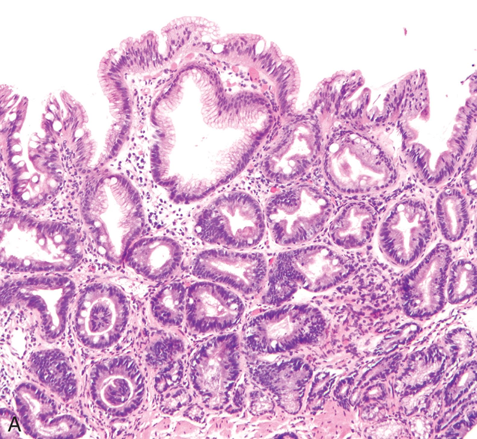 Figure 2.9, Barrett’s esophagus, negative for dysplasia ( A ). The basal aspect of the crypts often appears regenerative and may be mistaken for dysplasia. The presence of surface maturation, as illustrated in this case, argues against a diagnosis of dysplasia. A “wild-type” pattern of p53 immunoreactivity shows scattered nuclei with weak positive staining ( B ) and can sometimes be useful in confirming the morphologic impression. Routine use of p53 immunostain in all surveillance biopsies is not recommended.