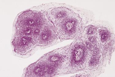 FIG. 8.1, Benign esophageal squamous papilloma of exophytic type.