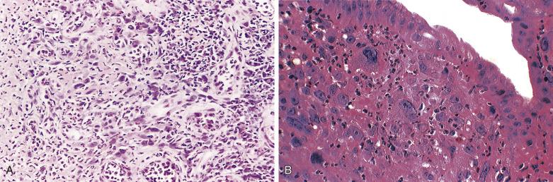 FIG. 8.11, Pleomorphic spindle cells and endothelial cells in granulation tissue (A) from a biopsy of a benign lower esophageal ulcer and (B) in a small inflammatory polyp at the gastroesophageal junction.