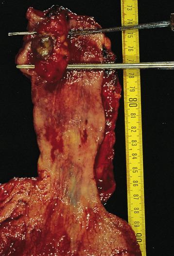 FIG. 8.12, The typical spindle cell carcinoma of the esophagus is a polypoid tumor on a narrow pedicle.