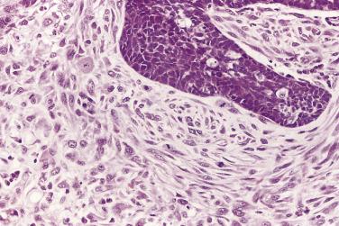 FIG. 8.13, Spindle cell carcinoma. Both the epithelial and spindle components show cytologic features of malignancy.