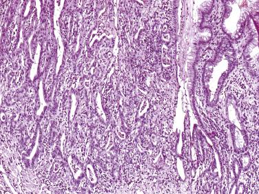 FIG. 8.14, Adenocarcinoma arising in Barrett esophagus. Metaplastic intestinal-type epithelium is seen in the right side of the field.