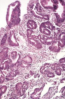 FIG. 8.15, High-grade dysplasia in metaplastic glandular epithelium of Barrett esophagus.