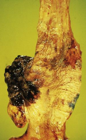 FIG. 8.17, Pigmented esophageal malignant melanoma with melanosis of the background mucosa.