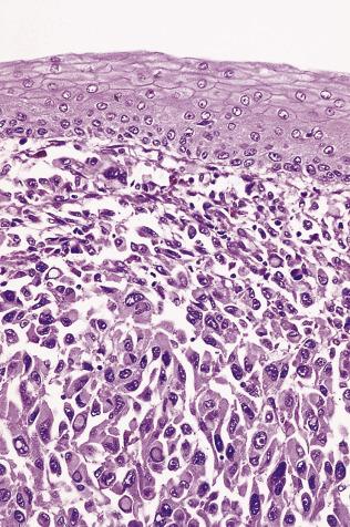 FIG. 8.18, Malignant melanoma of the esophagus.