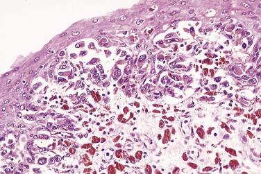 FIG. 8.19, Lentiginous radial component of malignant melanoma adjacent to the tumor in Fig. 8.18 .