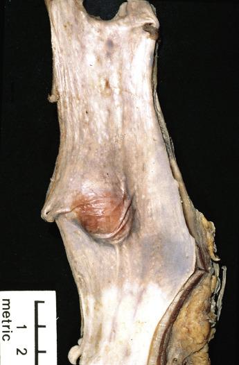 FIG. 8.20, Polypoid esophageal leiomyoma.