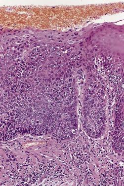 FIG. 8.2, High-grade dysplasia of esophageal squamous epithelium adjacent to an invasive squamous cell carcinoma.