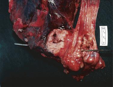 FIG. 8.21, Leiomyosarcoma of the esophagus invading the mediastinum and adjacent lung.