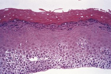 FIG. 8.3, Esophageal biopsy from a patient with tylosis showing parakeratosis and hypergranulosis of the squamous epithelium, recently termed epidermal metaplasia .