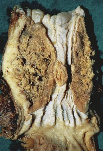 FIG. 8.4, Advanced ulcerating squamous cell carcinoma. The tumor virtually encircles the lumen of the esophagus.