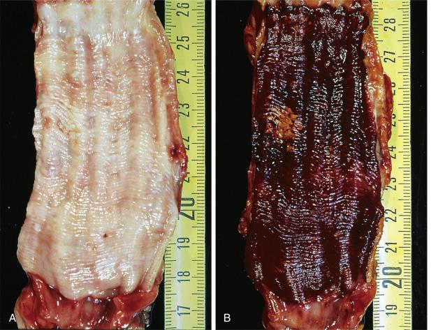 FIG. 8.5, Superficial squamous cell carcinoma before (A) and after (B) applying Lugol solution. The tumor is inconspicuous in the fresh specimen but is highlighted by its relative lack of iodine staining.