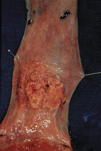 FIG. 8.6, Early (superficial) squamous cell carcinoma of verrucous type.