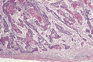 FIG. 8.7, Invasive well-differentiated keratinizing squamous cell carcinoma of the esophagus.