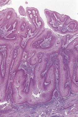 FIG. 8.9, Verrucous carcinoma of the esophagus.