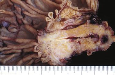 FIG. 11.1, Gross specimen of ductal adenocarcinoma in the head of the pancreas showing invasion of the ampulla and the duodenal wall and obstruction of the common bile duct and the pancreatic duct.