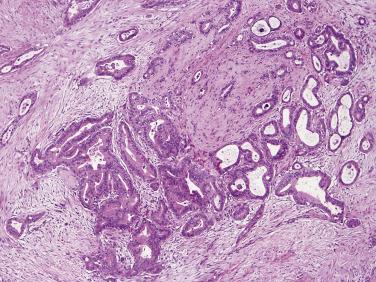 FIG. 11.2, Ductal adenocarcinoma with infiltrating well-formed tubular and glandular structures and abundant stromal desmoplasia.