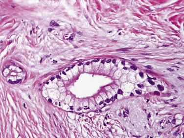 FIG. 11.3, Ductal adenocarcinomas with foamy cell–like features: well-formed glands with microvesicular, clear cytoplasm and the thick eosinophilic apical cytoplasmic band.