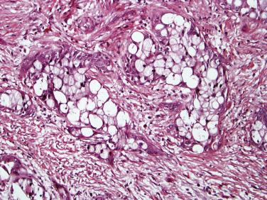 FIG. 11.4, Ductal adenocarcinoma with clear cell features.