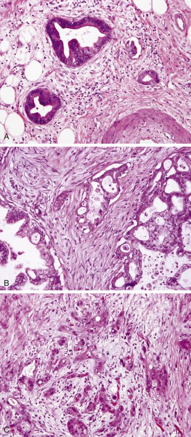 FIG. 11.5, Ductal adenocarcinoma, grading. (A) Well-differentiated ductal adenocarcinomas composed of remarkably well-formed simple glands; note adjacency to large muscular vessel (lower right) and focus of lymphatic invasion. (B) Moderately differentiated carcinoma consists of irregular glands, some cribriformed, with solid cell clusters; more marked nuclear pleomorphism is seen. (C) Poorly differentiated carcinoma consists predominantly of solid clusters and individual cells with marked nuclear atypia.