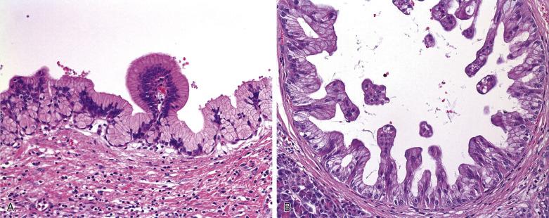 FIG. 11.6, Pancreatic intraepithelial neoplasia, low grade (A) and high grade (B).