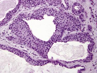 FIG. 11.7, Pancreatic duct with squamous metaplasia. Note lack of keratinization.