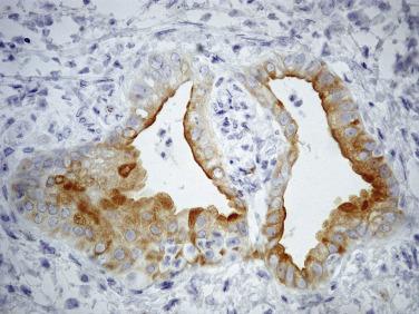 FIG. 11.8, Ductal adenocarcinoma, well differentiated, staining for MUC1.