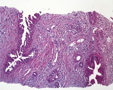 FIG. 11.10, Needle biopsy specimen from a well-differentiated ductal adenocarcinoma showing glands with papillary epithelium.