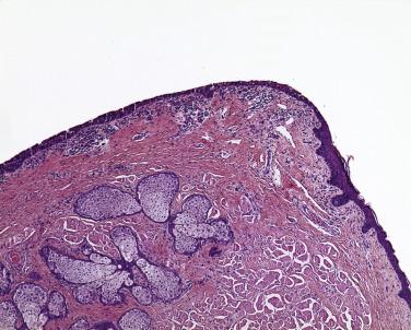 FIG. 29.1, The mucocutaneous margin of the eyelid is illustrated in this micrograph. Because most eyelid neoplasms originate at this site, the pathologist should insist on examining a tissue section that includes this transition zone when commenting on margins of a full-thickness eyelid resection. Note the absence of subcutaneous fat in the normal eyelid skin.