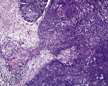 FIG. 29.11, Sebaceous carcinoma with focal squamous differentiation. Sebaceous carcinoma may mimic a variety of cutaneous neoplasms, including basal cell carcinoma.