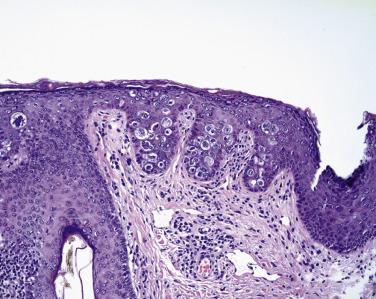 FIG. 29.12, Intraepithelial sebaceous carcinoma. The pagetoid spread of tumor is striking. Note the cytoplasmic clearing typical of sebaceous carcinoma.